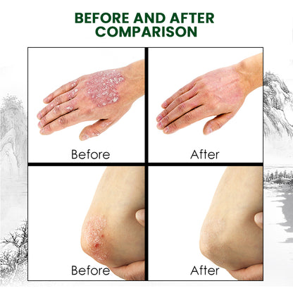 CREMA PSORIASIS UNGENTO